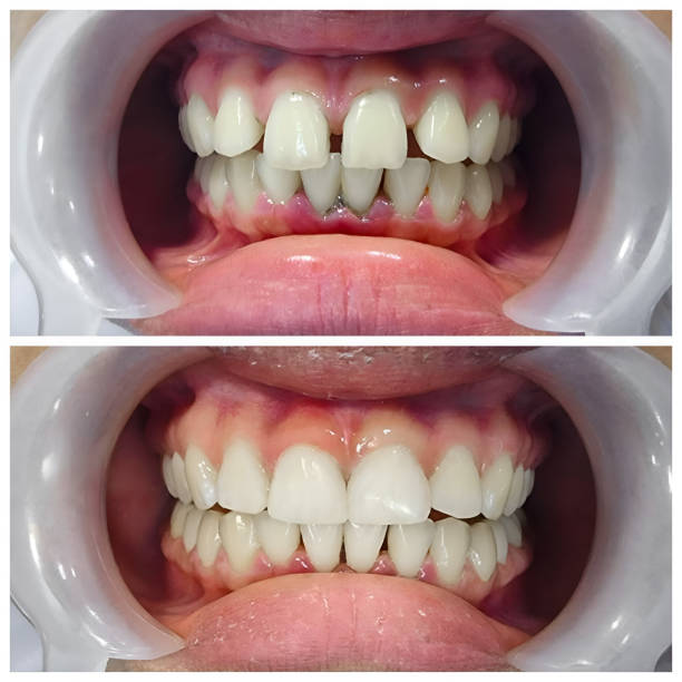 Full Mouth Reconstruction in Thomasboro, IL